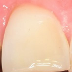 White Filling Front Tooth After