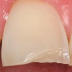 White Filling Front Tooth Before