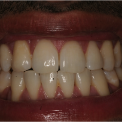 Zoom Whitening After